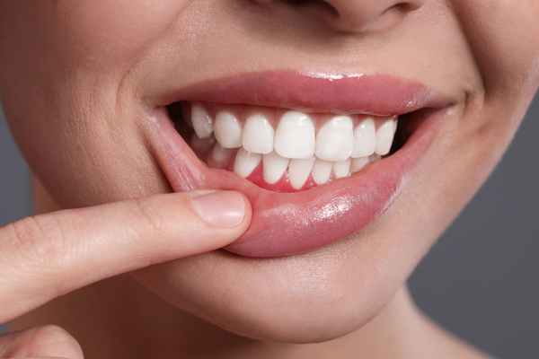Treating Gum Disease If You Have Gingivitis